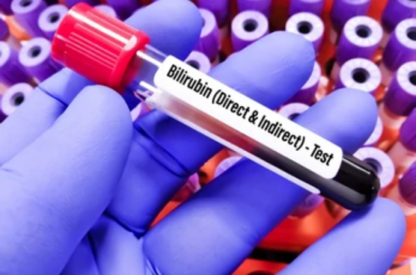 Direct Billirubin