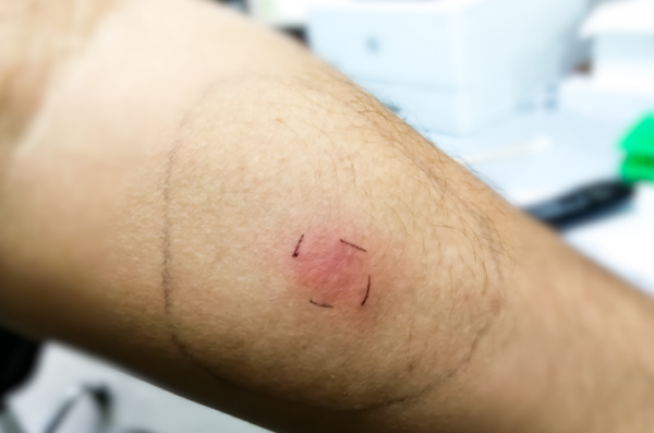 Mantoux Test